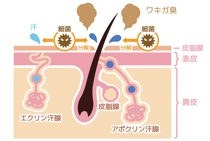 ワキガ（腋臭症・腋窩多汗症）の原因