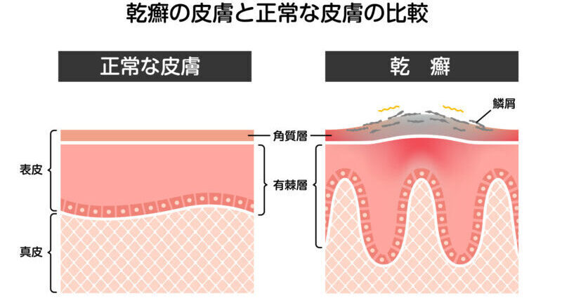 乾癬（かんせん）とは