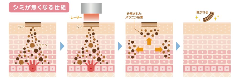 シミがなくなる仕組み