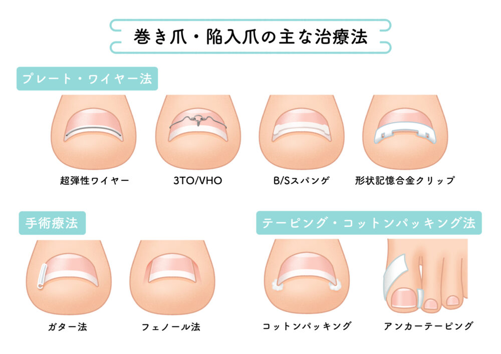 陥入爪・巻き爪の治療方法