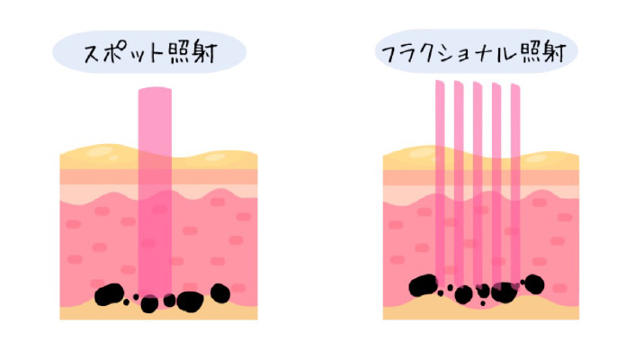ナノ秒（ナノセカンド）パルスによる安全な色素破壊