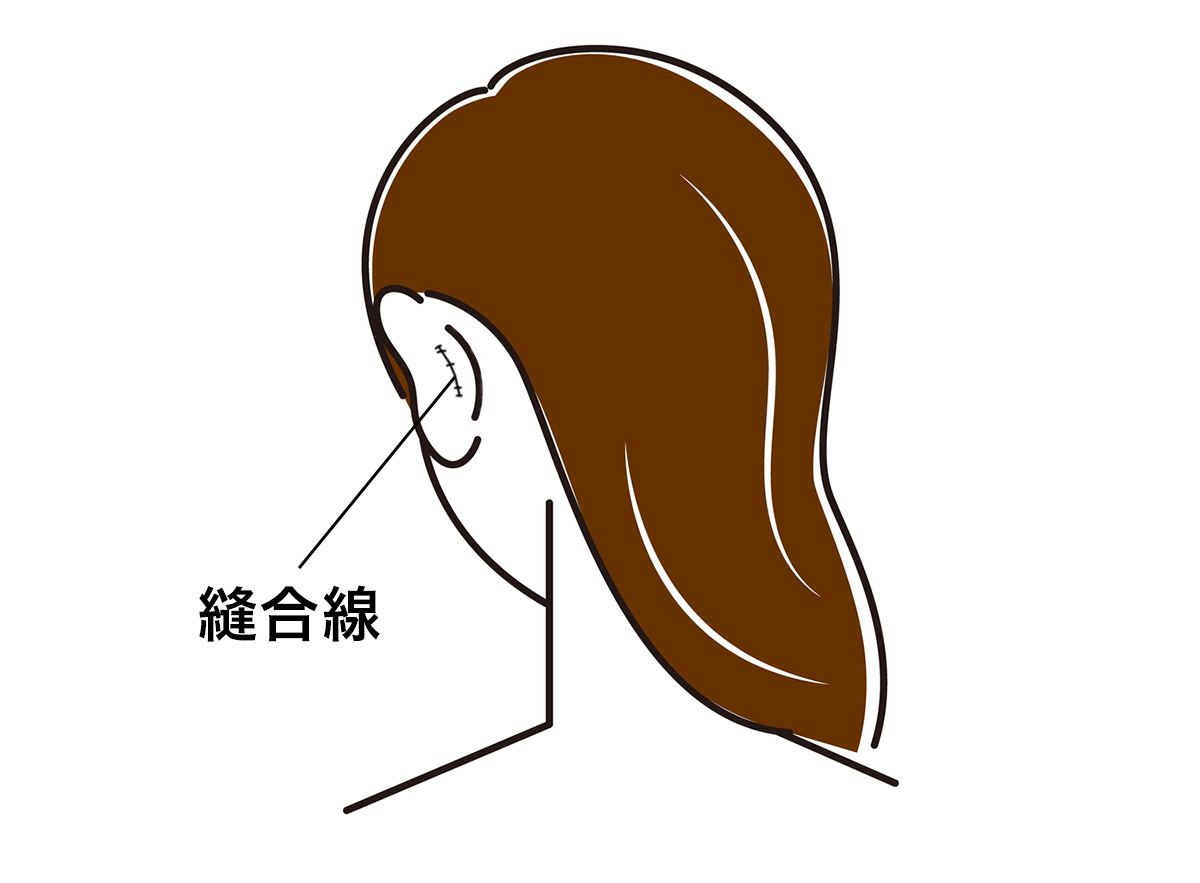 切開法（オープン法）
