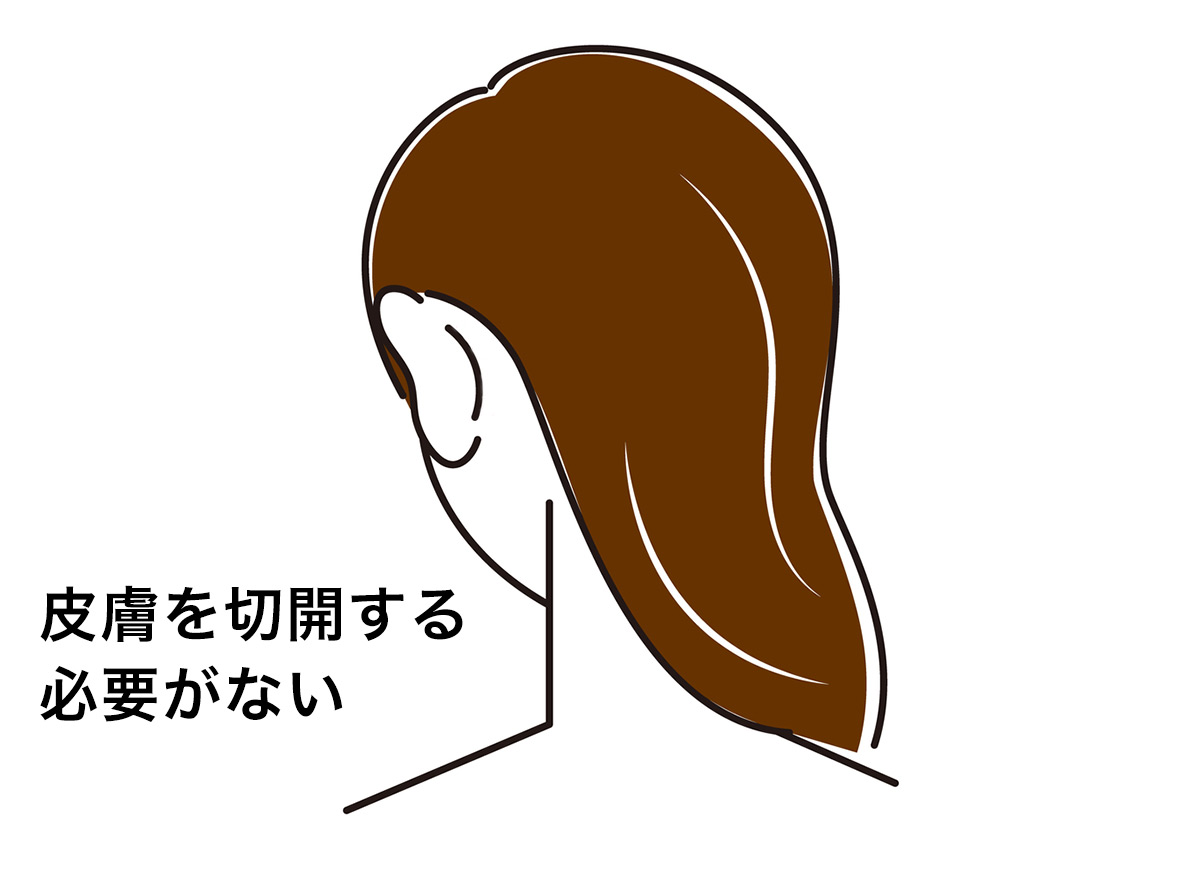 経皮法（低侵襲法）