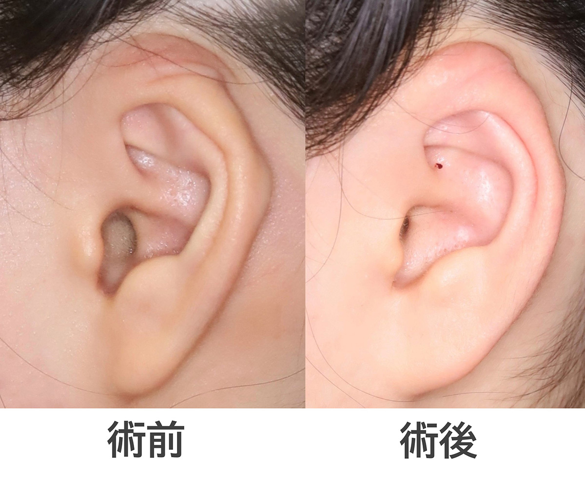 埋没耳